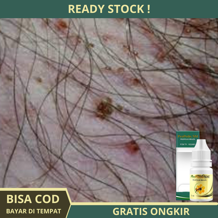 Terbaru Obat Kutu Kelamin - Kutu Kemaluan - Rambut Kutu Kelamin Promo Terlaris