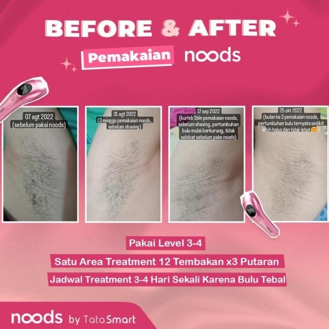 Noods - Alat Penghilang Bulu Permanen Ipl Hair Removal Home Device