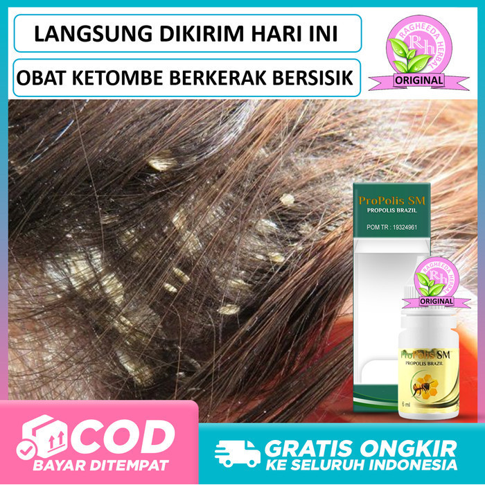 Obat Ketombe Berkerak, Kulit Kepala Sisik Kering, Dermatitis Seboroik