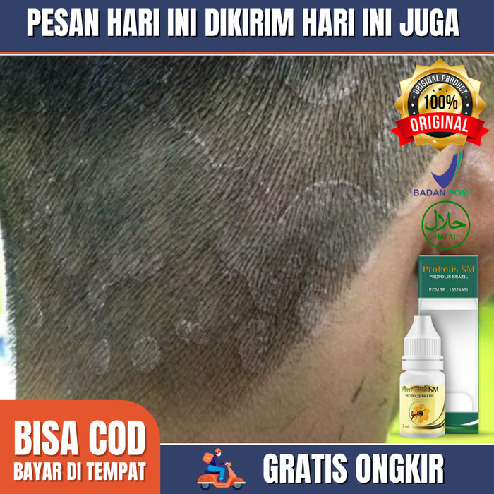 Obat Kulit Kepala Gatal Berjamur, Jamur di Kulit Kepala- Obat Propolis