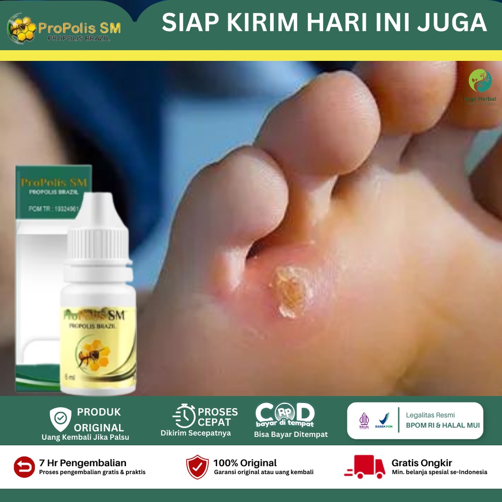 Obat Mata Ikan Di Jari Kaki, Obat Infeksi Mata Ikan, Obat Penghilang Mata Ikan, Mata Ikan Membengkak