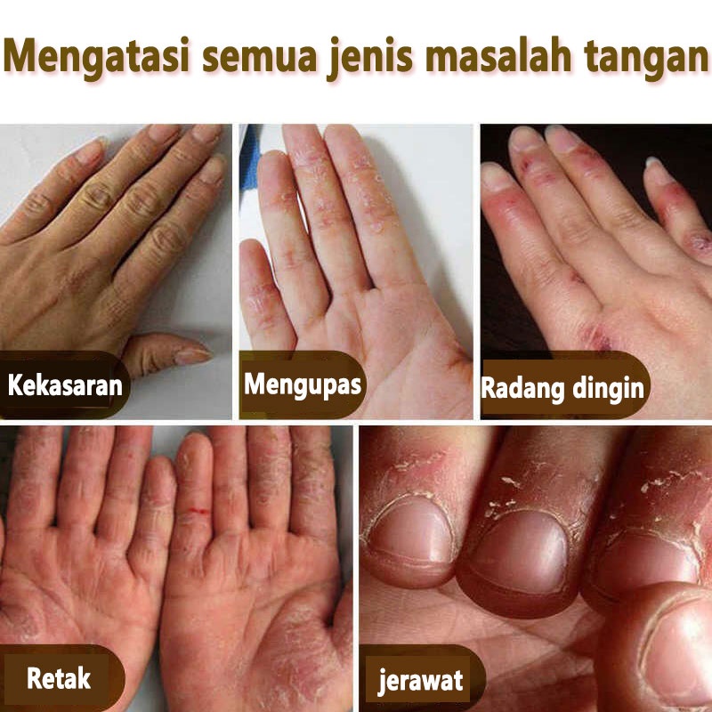 Serum Perawatan Tangan Krim Memutihkan Dan Anti Retak Ellen Ella Handcream Asam Hialuronat Kering