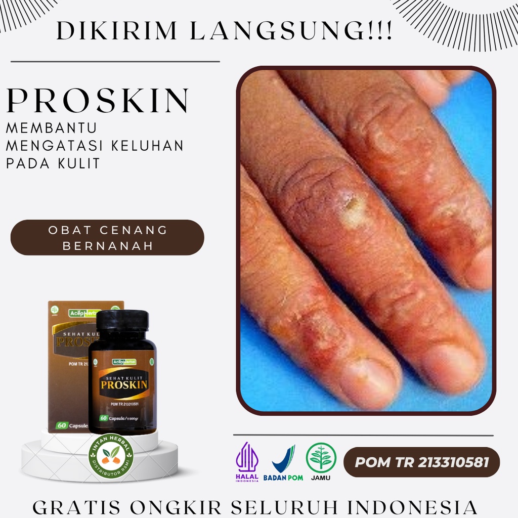 Obat Cenang Bernanah, Gatal Bernanah, Luka Borok Bernanah, Cenang Di Tangan & Kaki, Koreng Bernanah,