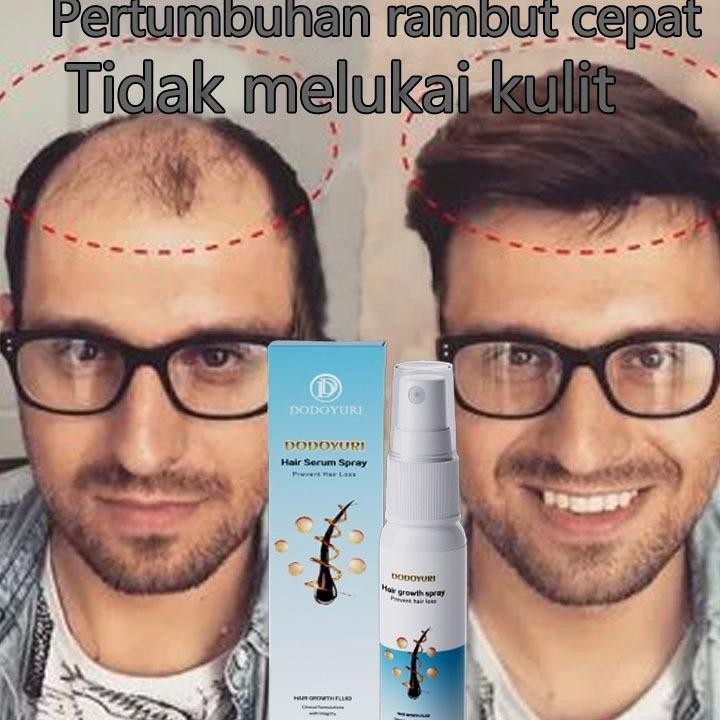 [Bpom] Umbuh Rambut Cepat Obat Umbuh Rambut Serum Umbuh Rambut Umbuh Rambut Botak 30Ml Kontrol Nyak 
