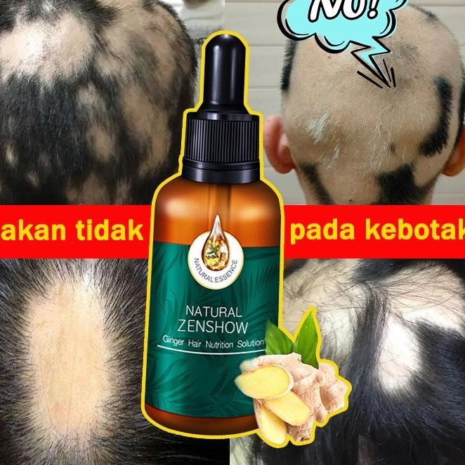 Obat Umbuh Rambut-Umbuh Rambut Ampuh Dan Cepat-Obat Umbuh Rambut Botak-Umbuh Rambut Secara Cepat-Hai