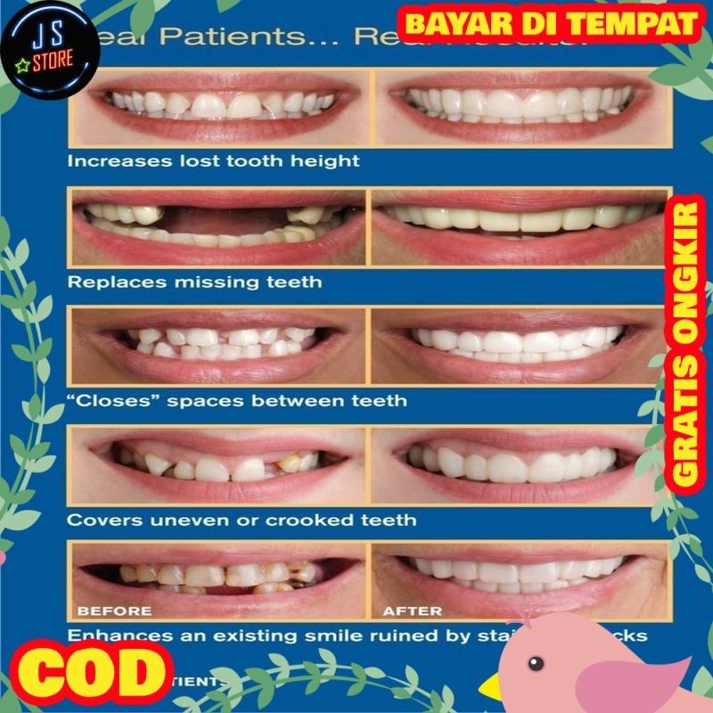 HOT Snap on Smile Veneers - Gigi Perfect Smile Tiruan Palsu Awet SF99