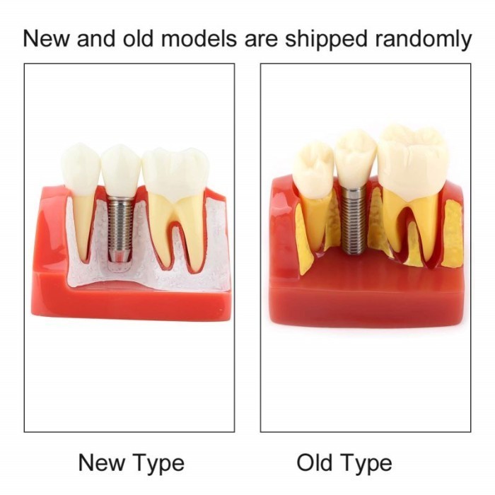Baru Crown Bridge Dental Model Alat Peraga Gigi Model Gigi Edukasi