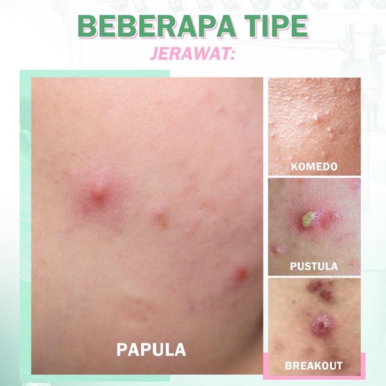 Berkualitas BNB barenbliss Pimple Warrior Salicylic Acid Acne Drying Lotion - Acne Spot Treatment Ca