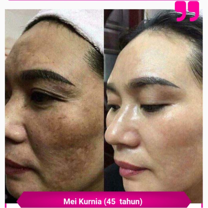 Again Beauty Penghilang Melasma Flek Hitam Pemutih Wajah