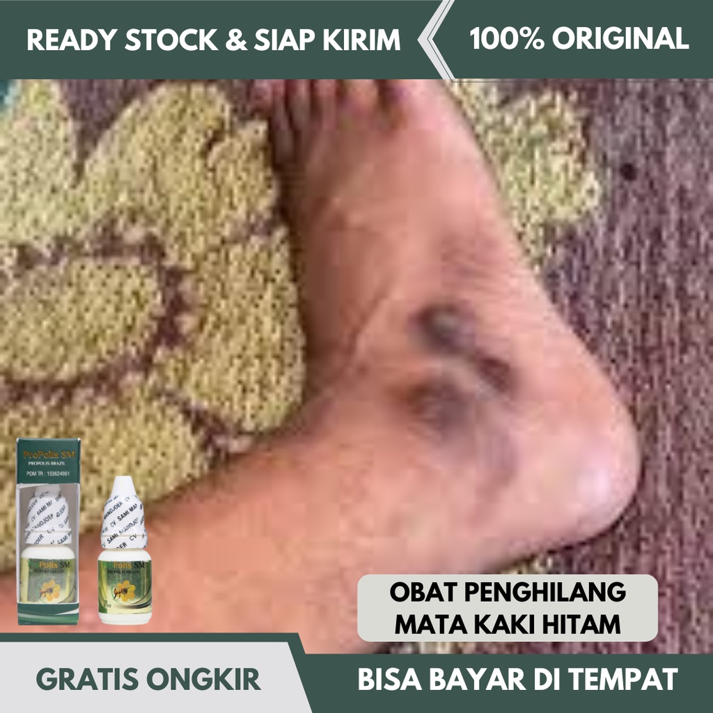 Obat Oles Mata Kaki Hitam, Obat Pemutih Mata Kaki Hitam, Obat Mata Kaki Hitam dan Kasar, Obat Mata K