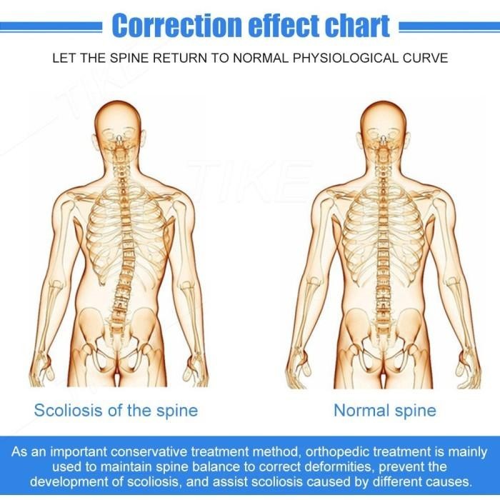Scoliosis Brace Pelurus Tulang Belakang Medis Scoliosis Corrector