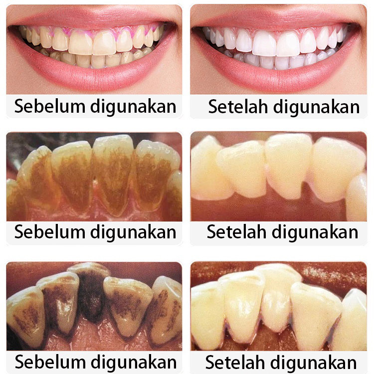 Perontok karang gigi Pemutih gigi Odol pemutih gigi dan karang gigi Pemutih gigi kuning dan pemutih