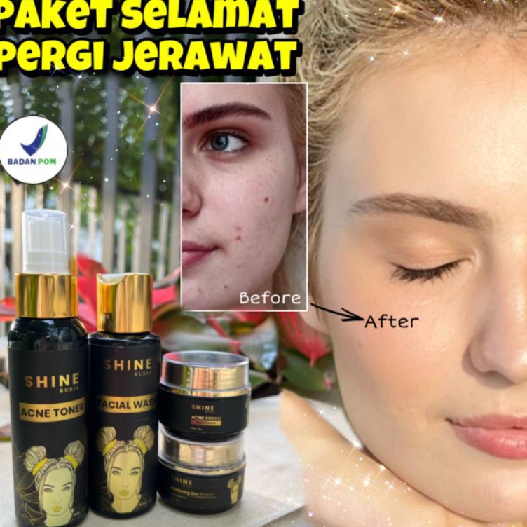 Kirim Sekarang Acne Package Shine Rusia BPOM