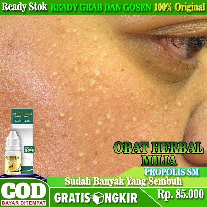 Obat Oles Milia - Penghilang Milia Alami - Hilangkan Milia Di Wajah Berkualitas