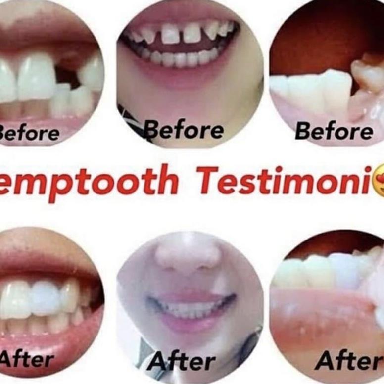 Limited - Penambal Gigi Berlubang Bolong Super Kuat Gigi Palsu Lem Gigi Padat Viral Di Titkok Gigi P