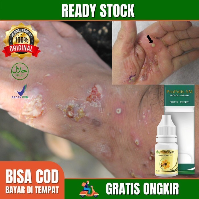 

Obat Kulit Borok Buduk Bernanah, Scabies Manusia, Dermatitis- Propolis