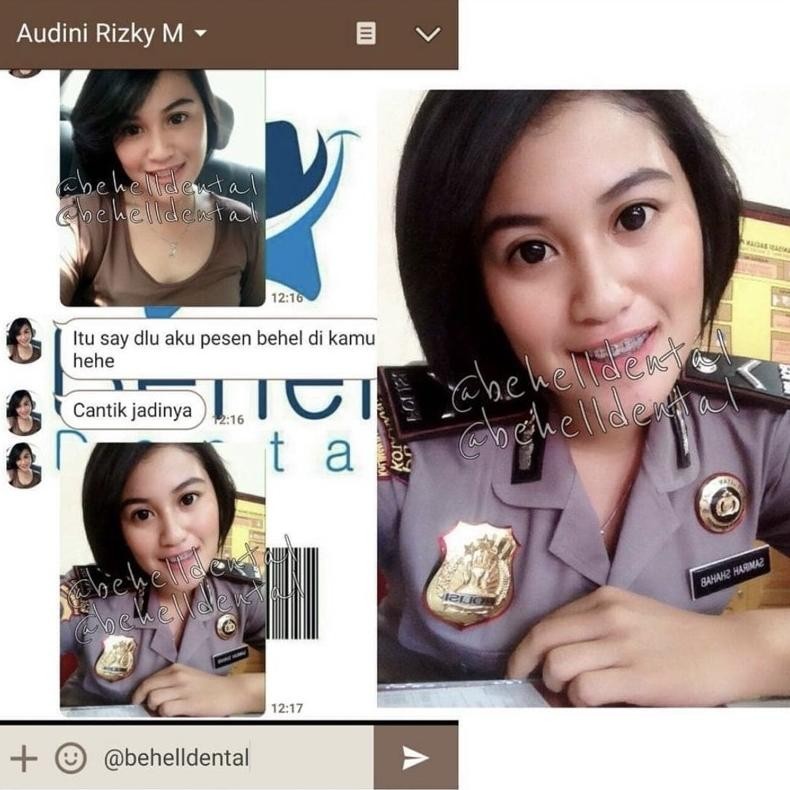 GH BRACKET BEHEL PERMANEN CERAMIC CLASSONE // KERAMIK TRANSPARAN TRANSFARAN CLEAR KAWAT GIGI BRACES 