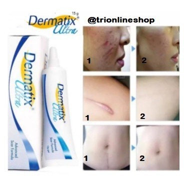 Dermatix Ultra Gel 15 Gr Salep Cream Penghilang Luka