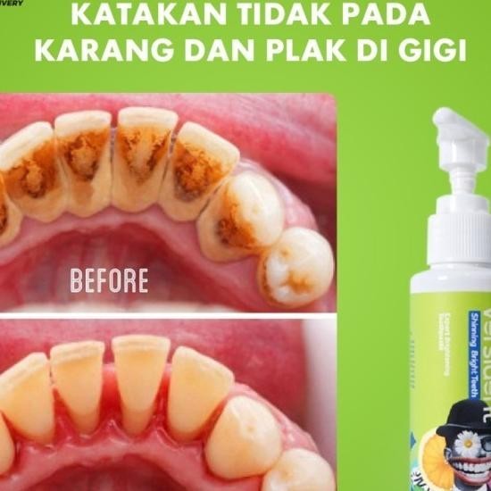 Versident Pasta Gigi Pemutih Gigi Pembersih Karang Gigi Bpom