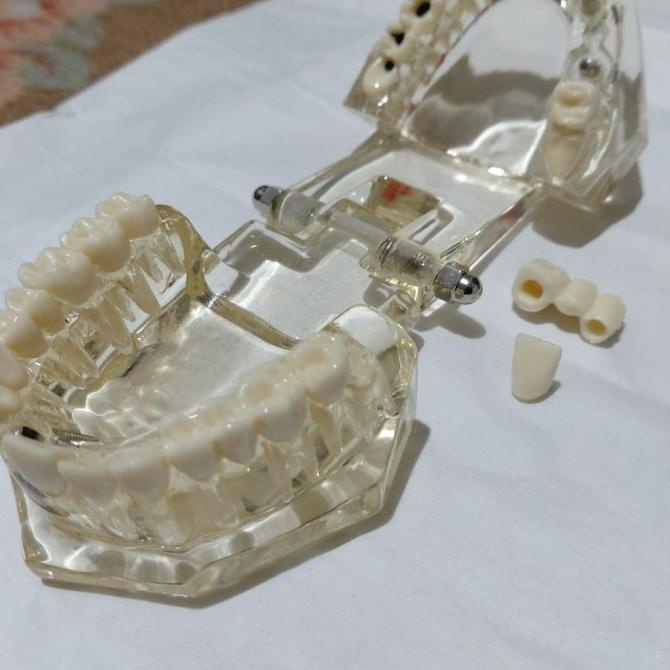 Dental Study Model Implan transparant typodont phantom gigi removable