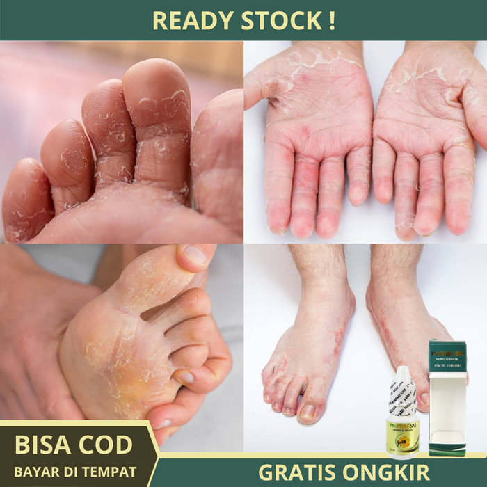 Terbaru Obat Kutu Air, Kutu Air Untuk Kaki, Kutu Air Tangan, Salep Kutu Air Promo Terlaris