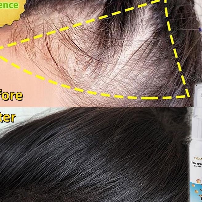 [Bpom] Umbuh Rambut Cepat Obat Umbuh Rambut Serum Umbuh Rambut Umbuh Rambut Botak 30Ml Kontrol Nyak 