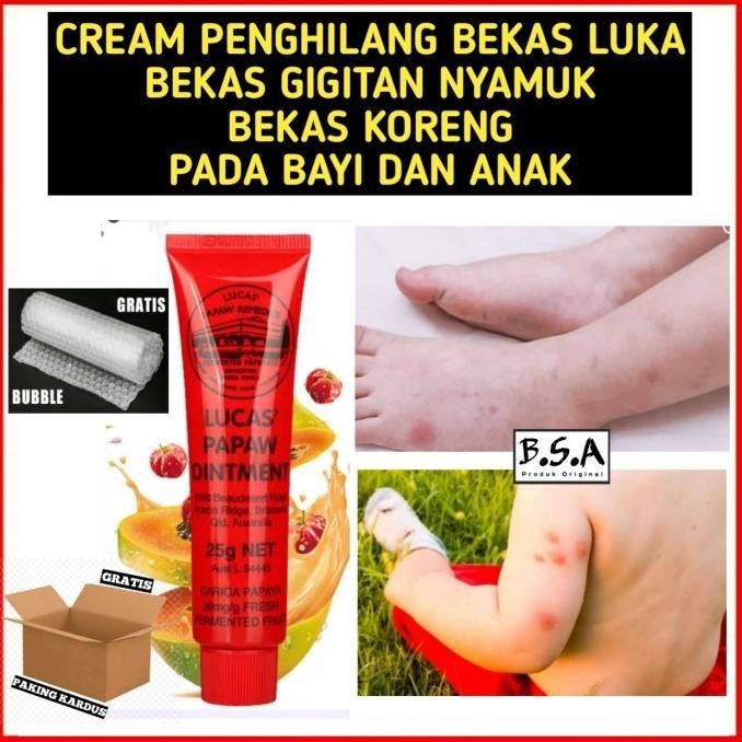 Cream Penghilang Bekas Luka Bekas Gigitan Nyamuk Pada Bayi Dan Anak