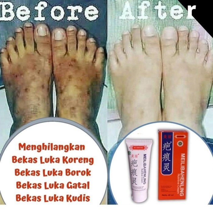 MURAH meilibahenling original asli salep penghilang bekas luka scar cream