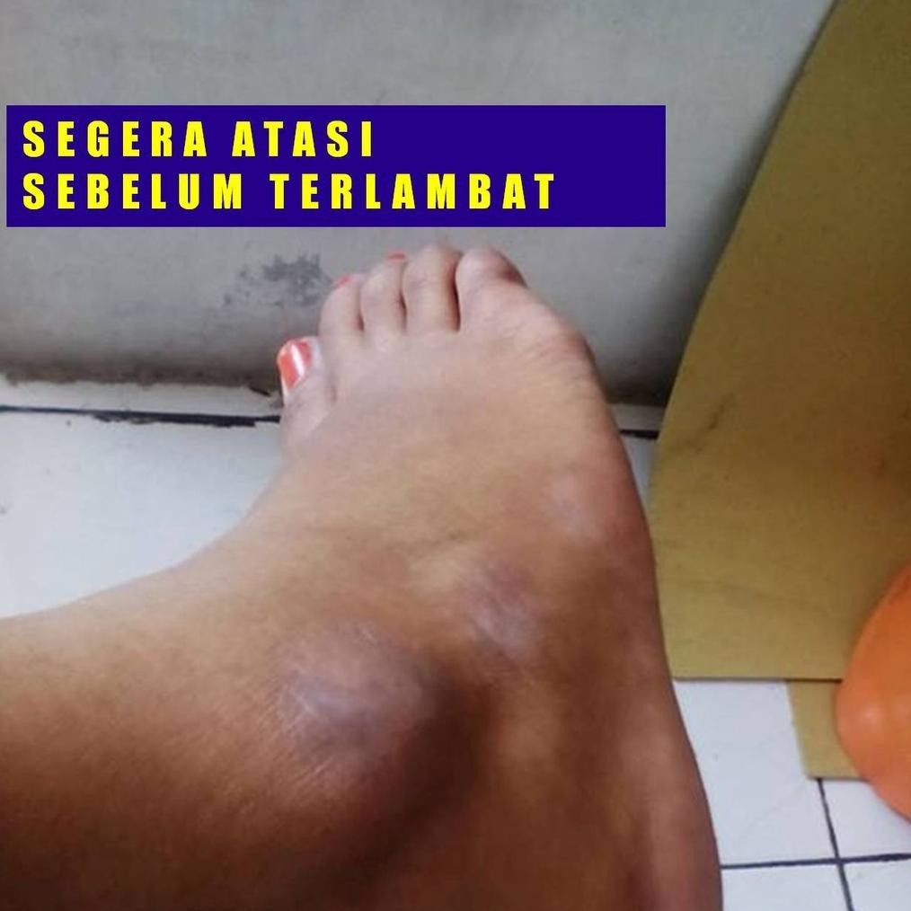 Salep Obat Mata Kaki Hitam Kapalan Kering Ampuh Tanpa Efek Samping Panas Perih Iritasi (6.6)