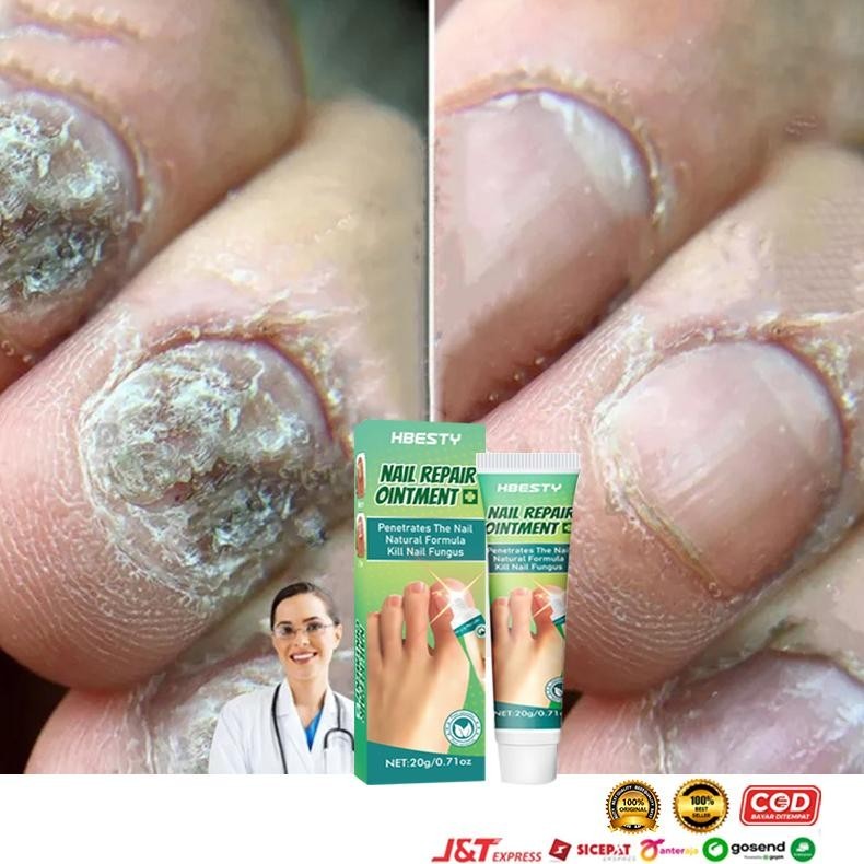 TERLARIS Obat Jamur Kuku obat kuku jamur dan rusak obat jamur kuku lanbena 20g Obat cantengan obat K