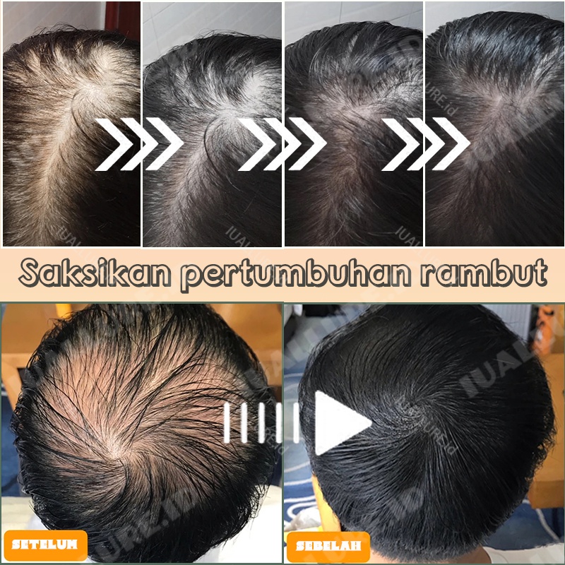 hair tonic rambut rontok/obat rambut rontok parah/tonic rambut rontok/serum rambut rontok dan