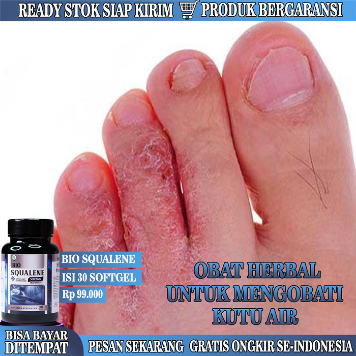 Terbaru Obat Kutu Air, Obat Kutu Air Pada Kaki , Obat Penghilang Kutu Air Promo Terlaris