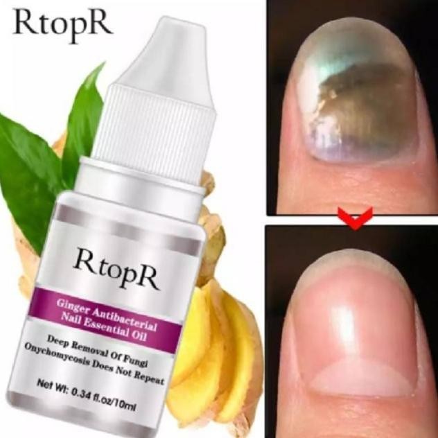 OBAT JAMUR KUKU OBAT PENGHILANG JAMUR KUKU AMPUH