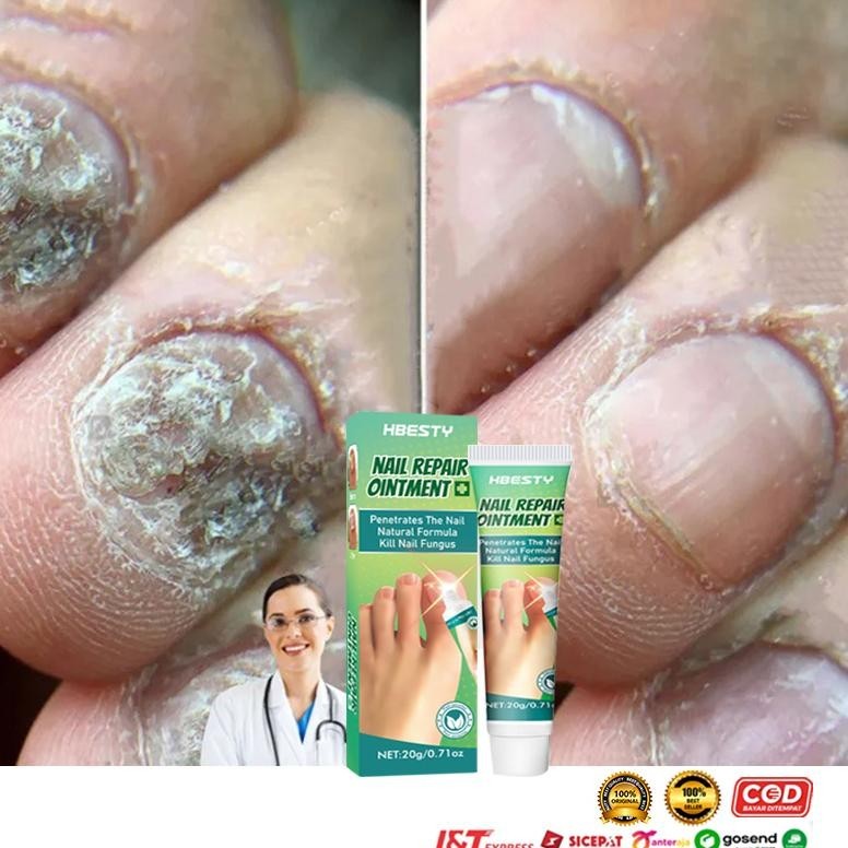 MURAH Obat Jamur Kuku obat kuku jamur dan rusak obat jamur kuku lanbena 20g Obat cantengan obat Kuku