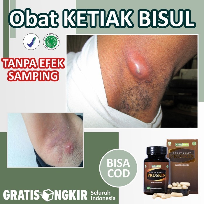 Obat Gatal Di Ketiak Bisul Di Ketiak Hitam Burik Herbal Proskin Alami
