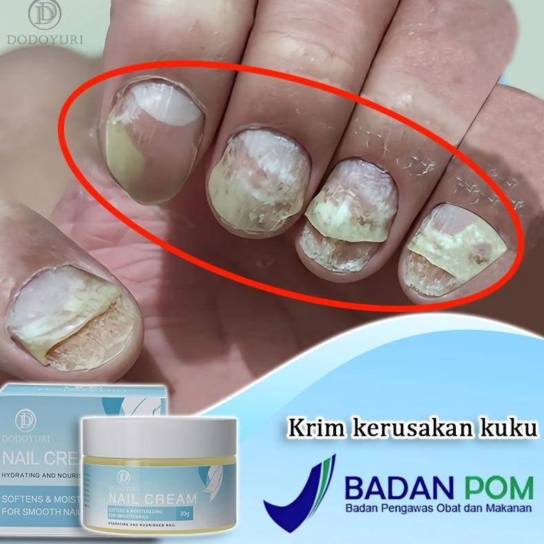 ii-99 BPOMSerum kuku jamur dan rusak obat kuku jamur dan rusak obat jamur kuku 30g obat kuku rusak p