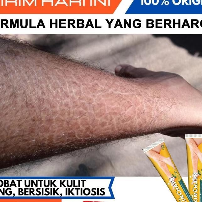 Lktiosis Kulit P Eksim Iktiosis Obat Jamur Kulit P Kulit Obat Gatal Kulit Krim Kaki Pecah Dan Kering