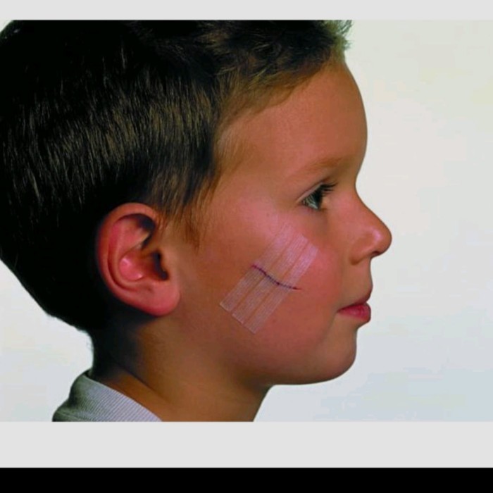 Terlaris 3m steri strip 6mm x 100mm R1546 luka tanpa jahit harga perpcs. SALE