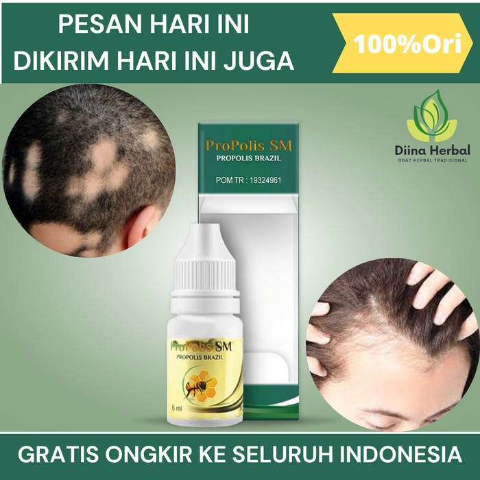 OBAT ALOPECIA AREATA, OBAT RAMBUT PITAK, OBAT PENUMBUH BOTAK KOIN