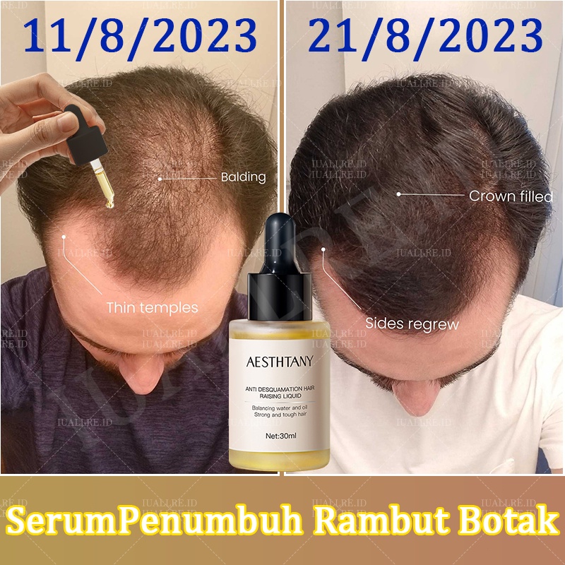 Hair Tonic Rambut Rontok/Obat Rambut Rontok Parah/Tonic Rambut Rontok/Serum Rambut Rontok Dan