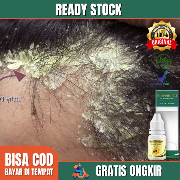 Promo Obat Kulit Seboroik Dermatitis, Ketombe Parah, Kulit Kepala Berjamur