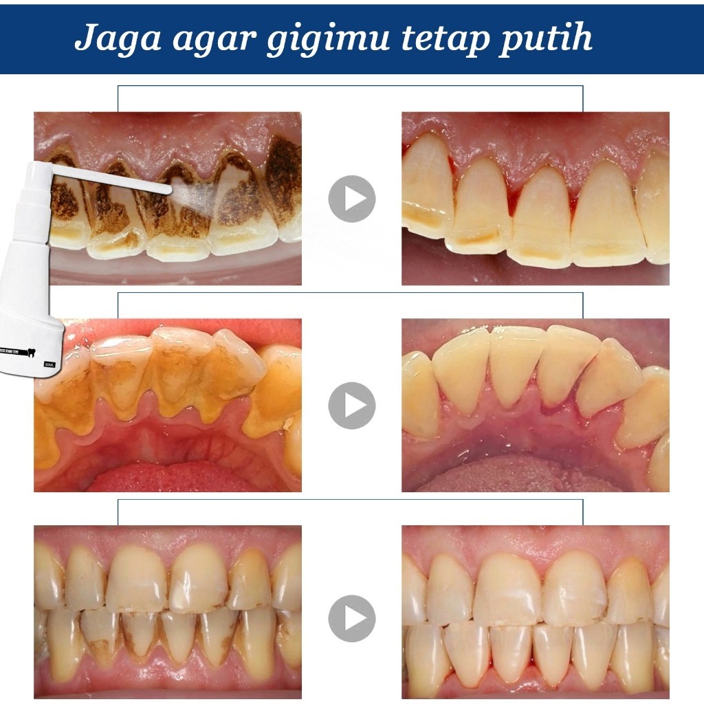 [READY] Pembersih karang gigi Penghilang karang gigi membandel alat pembersih karang gigi 30ml