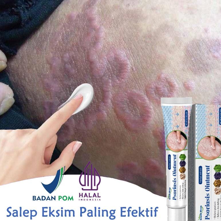 Obat Gatal Selangkangan Obat Kurap Salep Gatal China Paling Ampuh Salep Gatal Jamur Selangkangan 20m