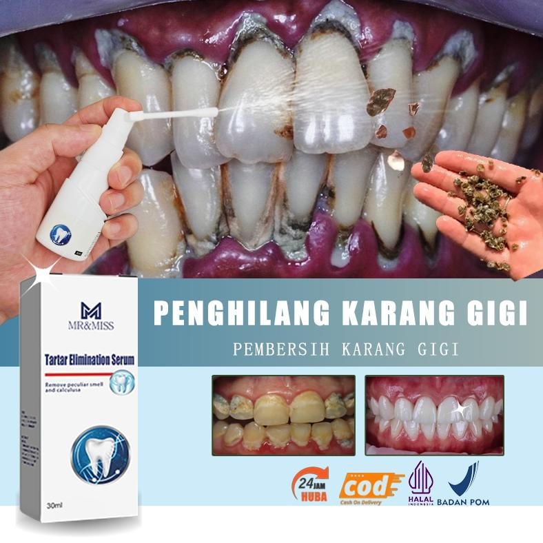 Perontok karang gigi paling ampuh Pembersih karang gigi Penghilang karang gigi 30ml Perontok karang 