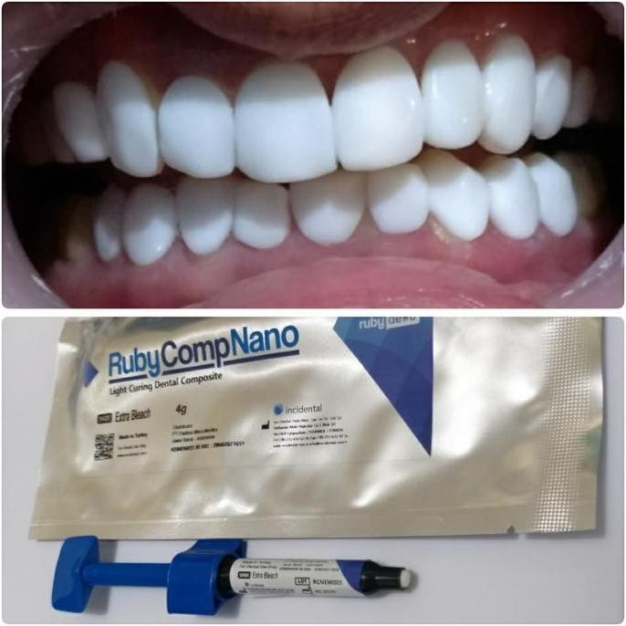 BEBAS ONGKIR - Composite Ruby Comp Nano Veneer EW 4gr | Made in Turkey