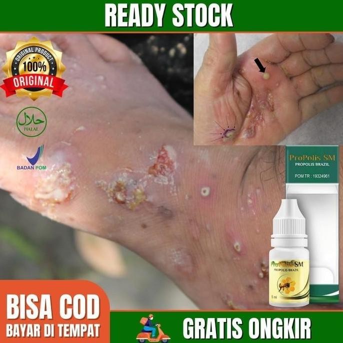 NEW Obat Salep Kulit Cenang Borok Budukan Bernanah Cacar Air Dermatitis
