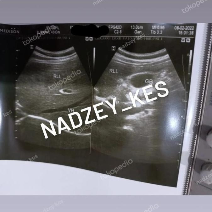 

Kertas Usg Sony Upp-110Hg High Glossy - Thermal Paper Compatible