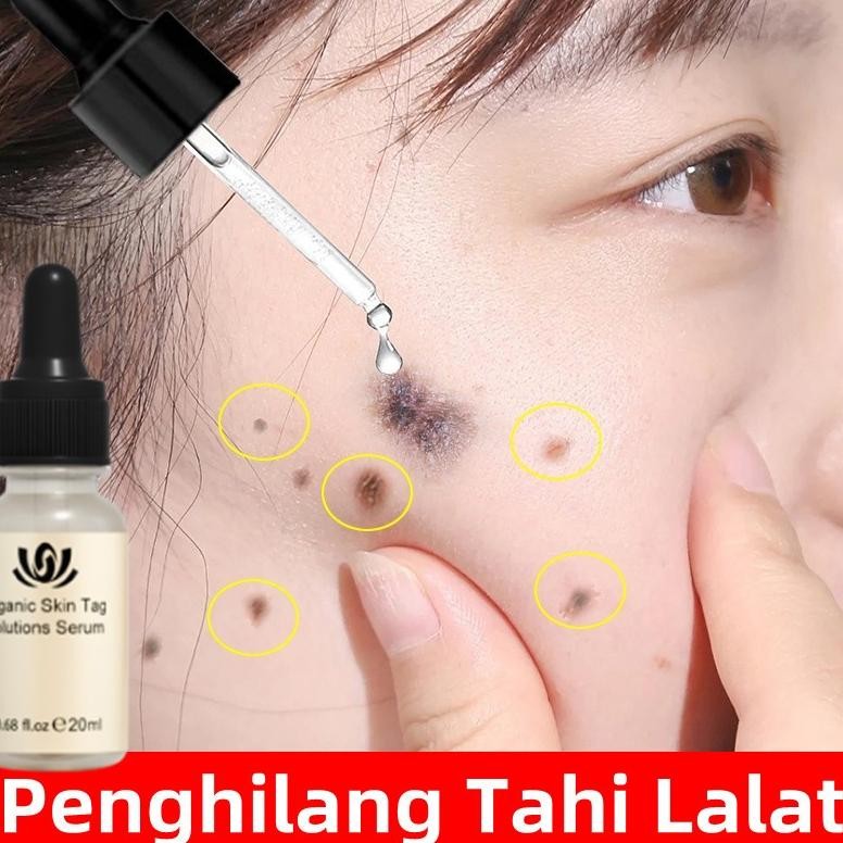 Penghilang Tahi Lalat Penghilang Kutil Skin Tag Remover Flek Dan Bintik Menghilangkan Pigmen Hitam K