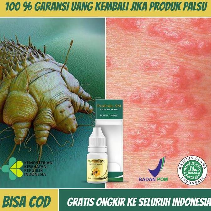 TERMURAH - Penghilang Scabies Dan Kutu Hewan Dikulit, Scabies Pada Kulit Manusia, Penghilang Kudis, 
