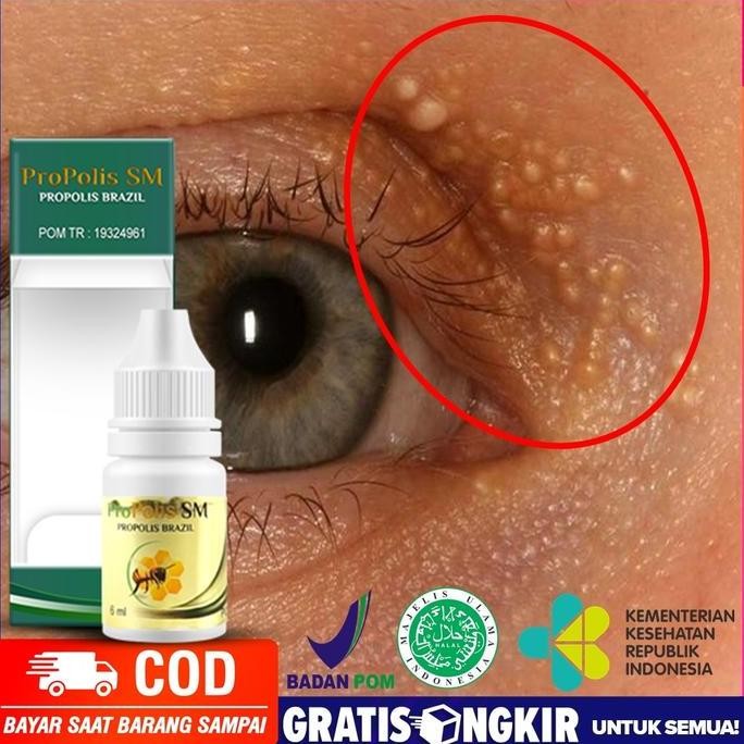 Propolis SM Obat Menghilangkan Milia, Jerawat Milia, Milia di Hidung